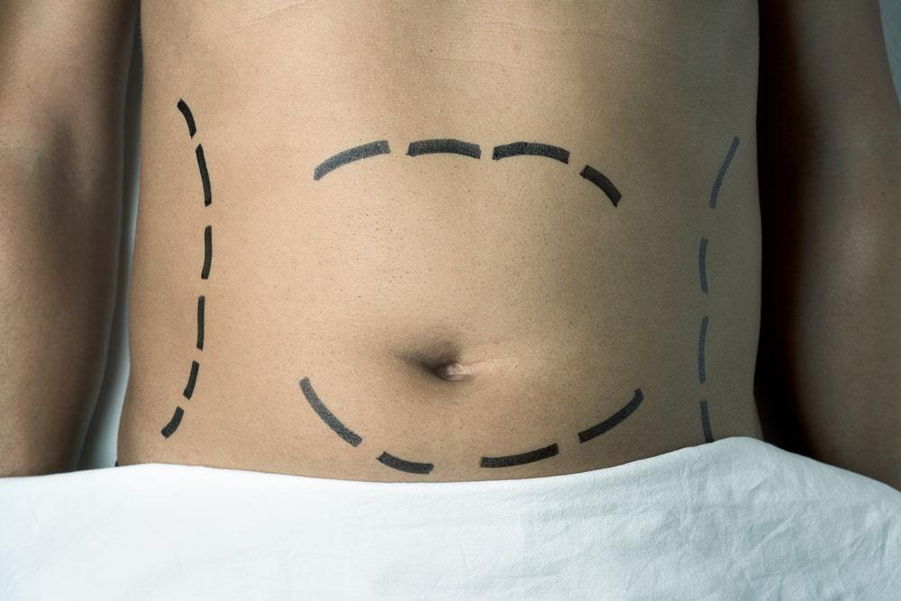 Tudo sobre a lipoescultura masculina