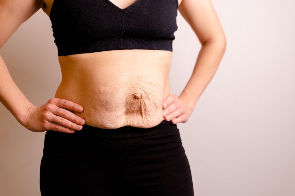 Tipos de diástase abdominal