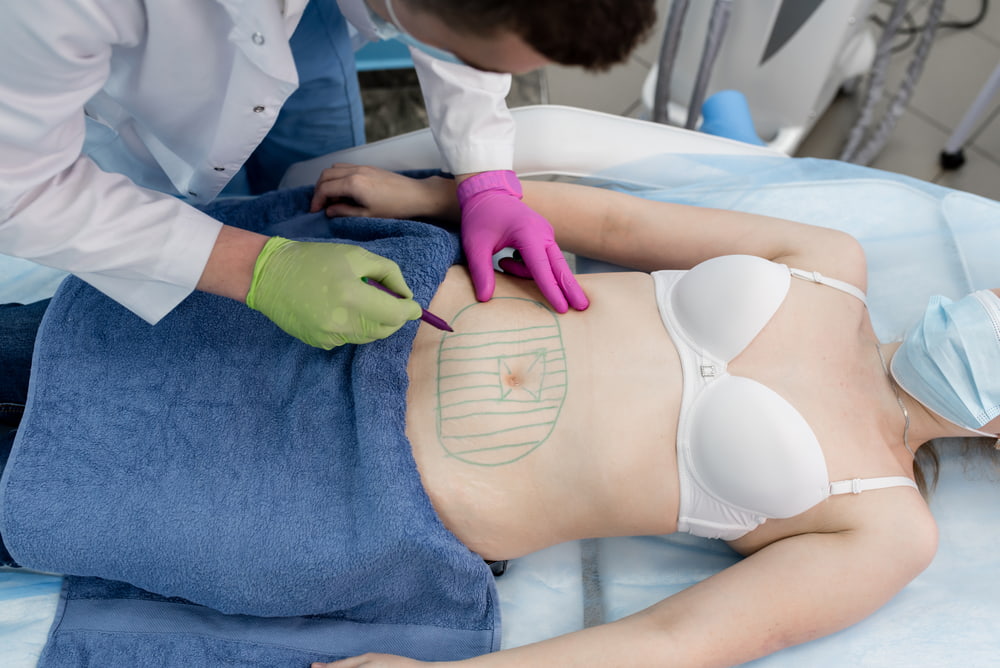 Médico especialista em abdominoplastia