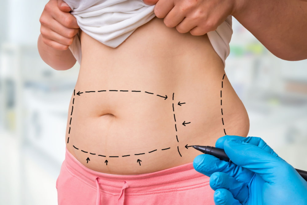 Como escolher um cirurgião plástico especialista em lipoescultura?