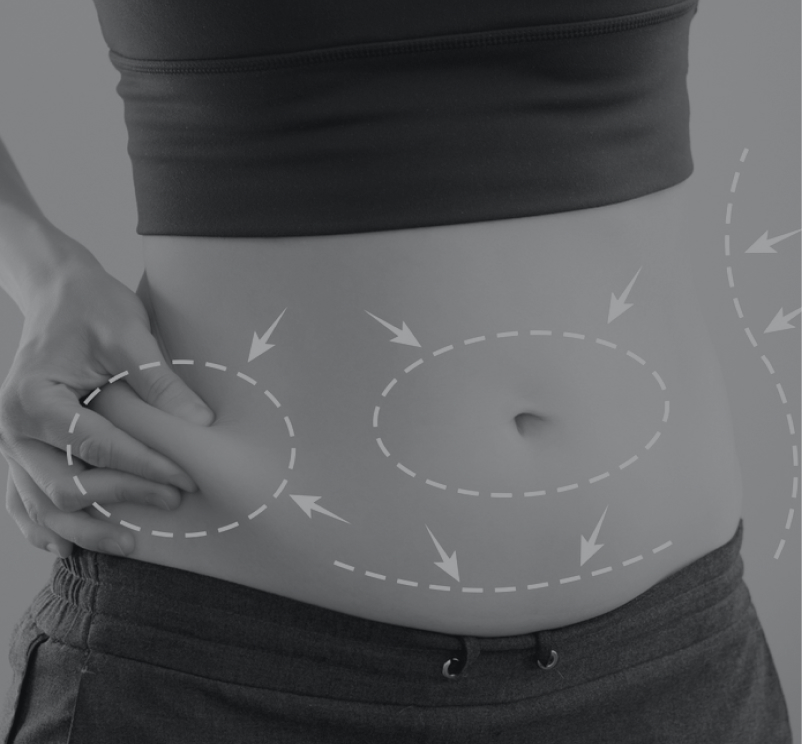 Abdominoplastia