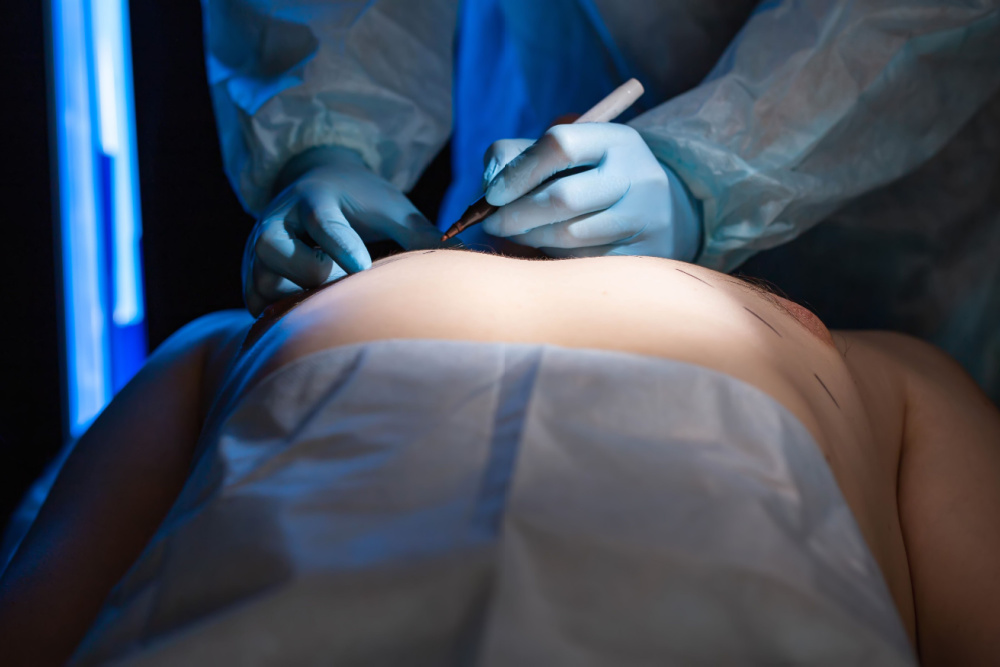 Ginecomastia: saiba tudo sobre o antes e depois da cirurgia