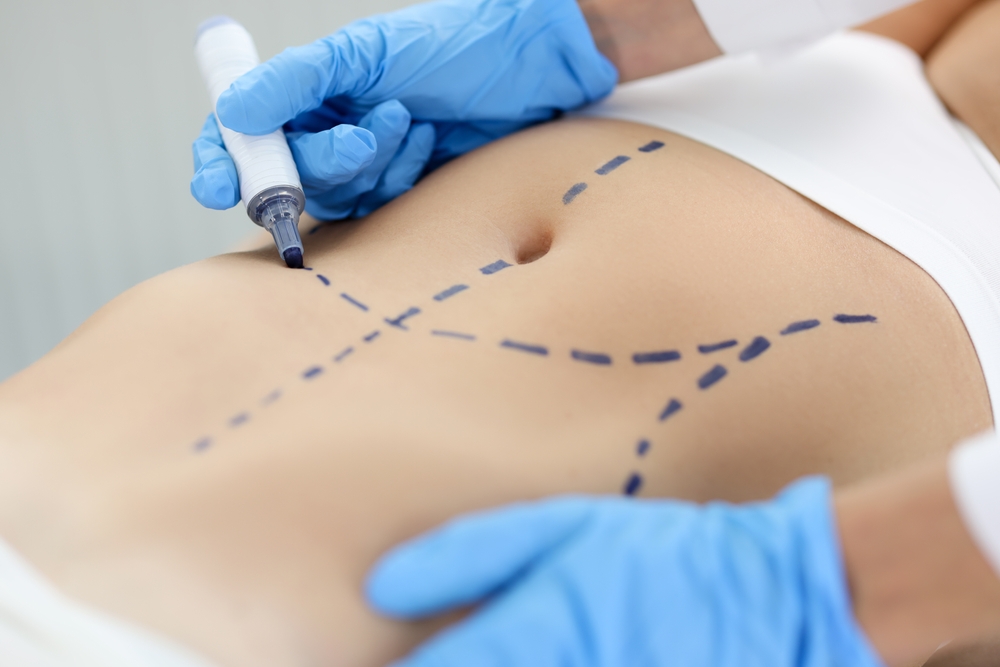 Diferenças entre miniabdominoplastia e abdominoplastia