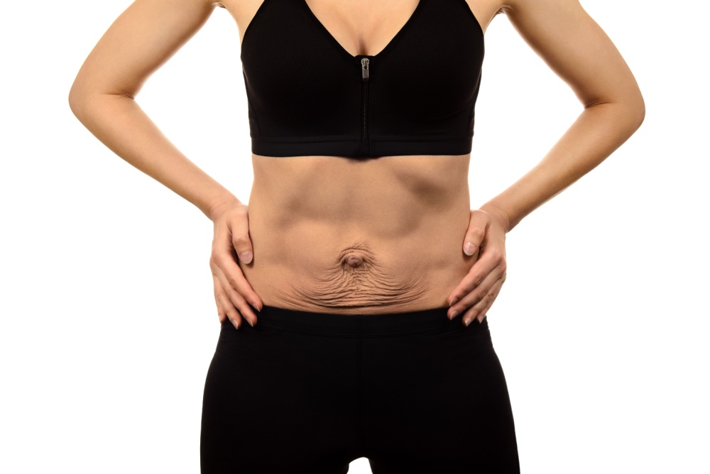 Correção de diástase abdominal: como é feita e qual a importância?