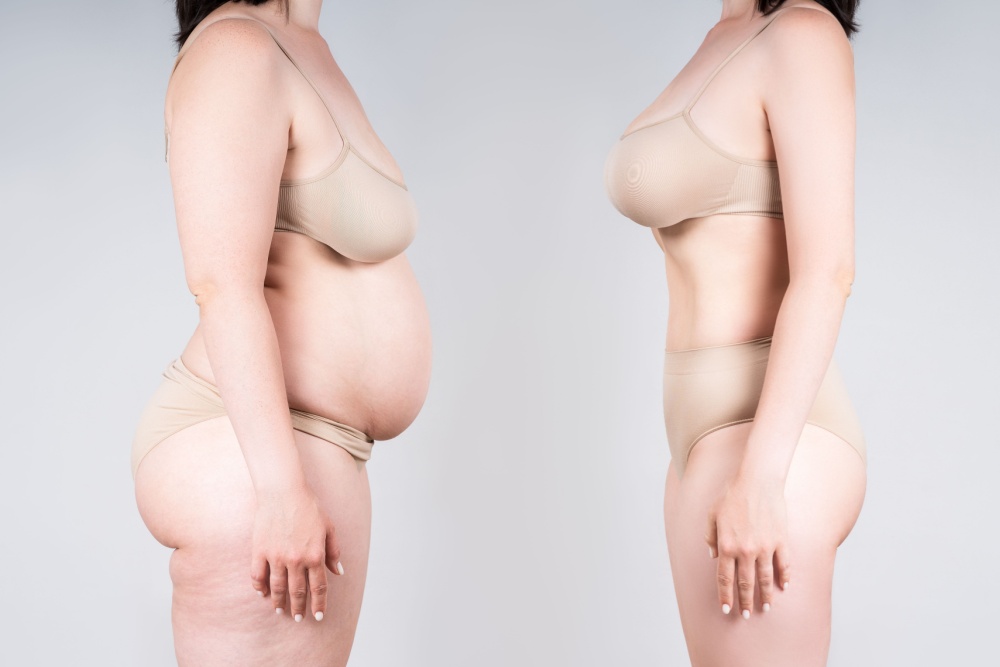 Abdominoplastia com lipo: tudo o que você precisa saber!
