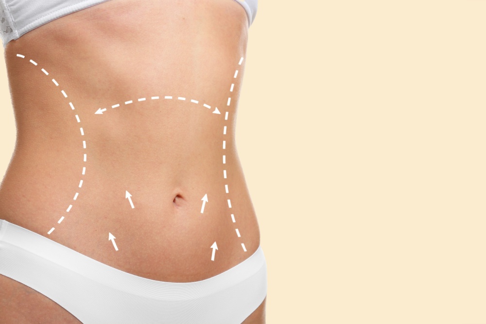 Abdominoplastia sem corte: como funciona?