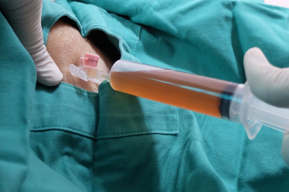 Seroma após abdominoplastia: o que é, como tratar e evitar?