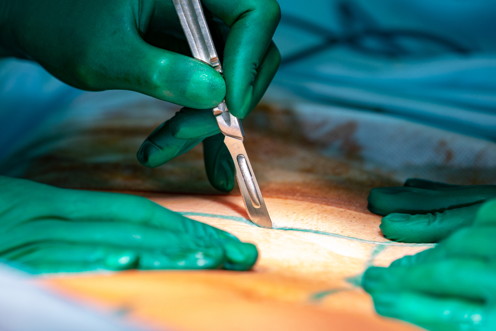 Umbigo na abdominoplastia: como cuidar e o que esperar?
