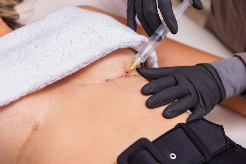 Cicatriz da mamoplastia redutora: quais cuidados tomar?