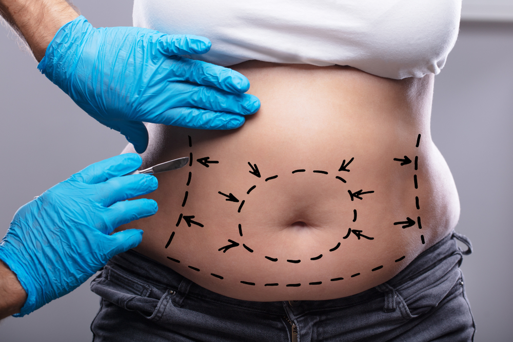 Abdominoplastia o Cirugía de Abdomen